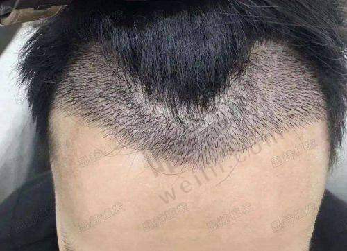 濡白天使填充眉弓的用量