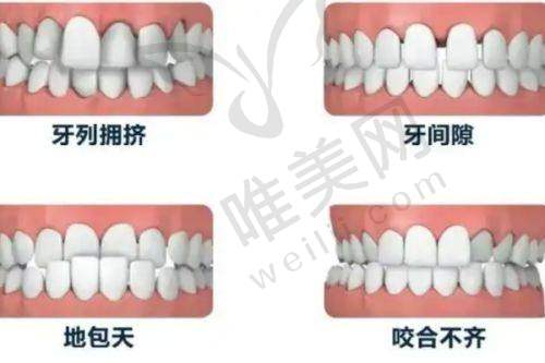 价格情况：珠海六和口腔透明合理，矫正性价比极高