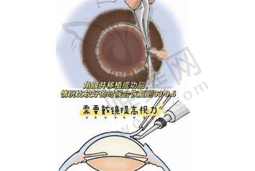 山西省眼科医院近视手术价格