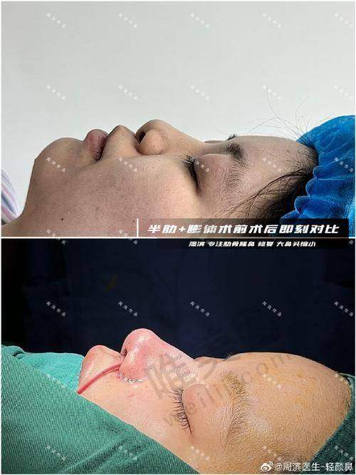 性价比之选：长效抗宽的瑞蓝丽瑅打鼻梁经济账