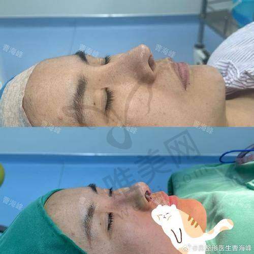 专研技术从源头扼杀瑞蓝丽瑅打鼻梁变宽风险