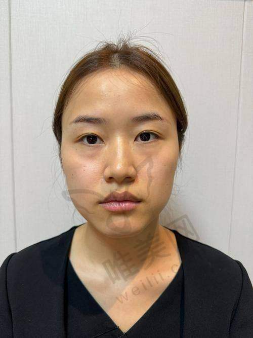 润致玻尿酸总体介绍