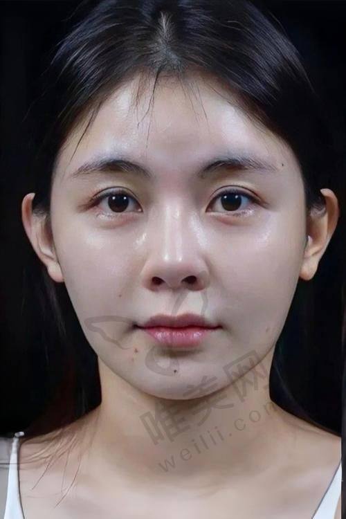 润致玻尿酸产品优势及使用提醒