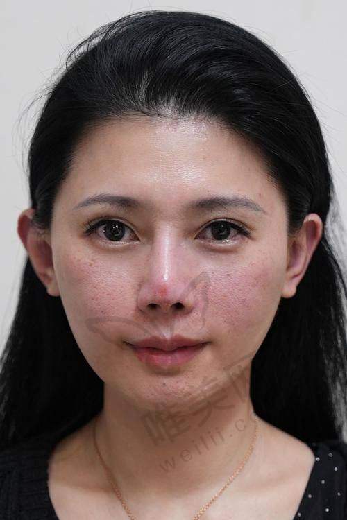 法欧曼玻尿酸为啥便宜