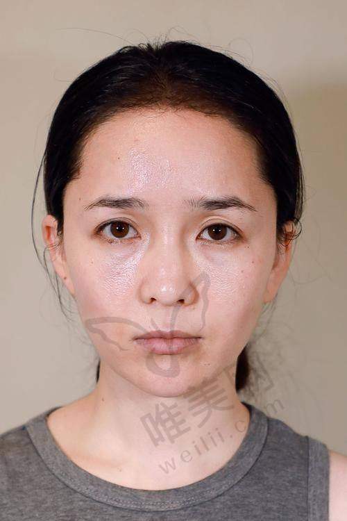 法欧曼玻尿酸注射体验