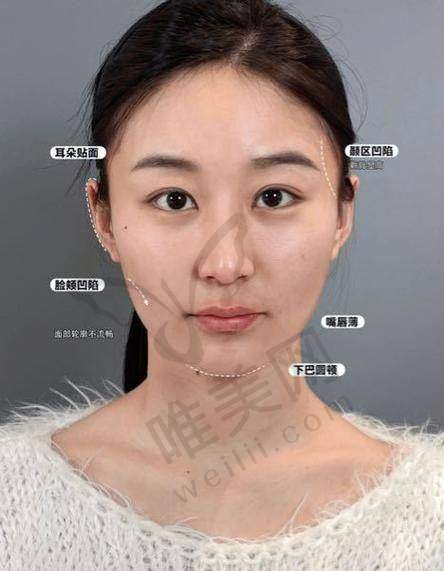 法欧曼玻尿酸成分与交联技术