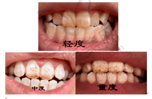霸州木易口腔诊所：专注儿童早期矫正的霸州牙科矫正诊所