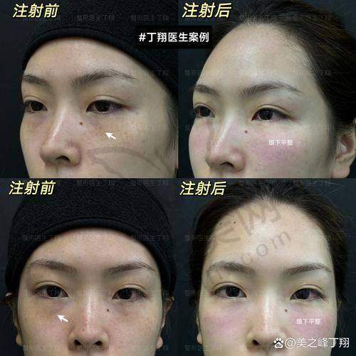厦门填充泪沟价格VS成效双测评