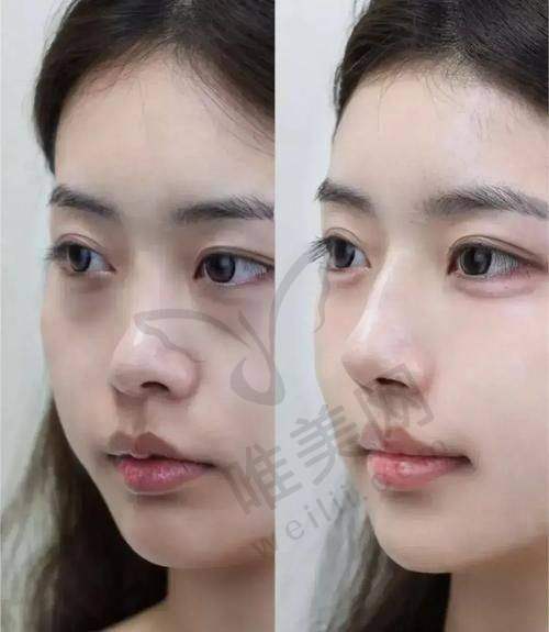 赫思美骨胶原注射疗效