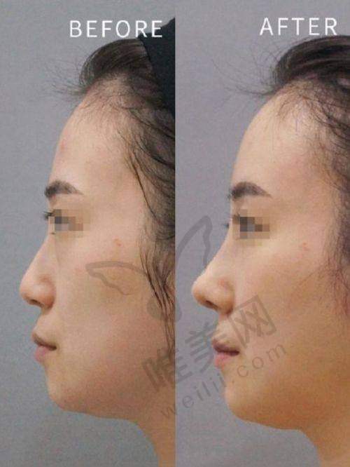 赫思美注射地点选择