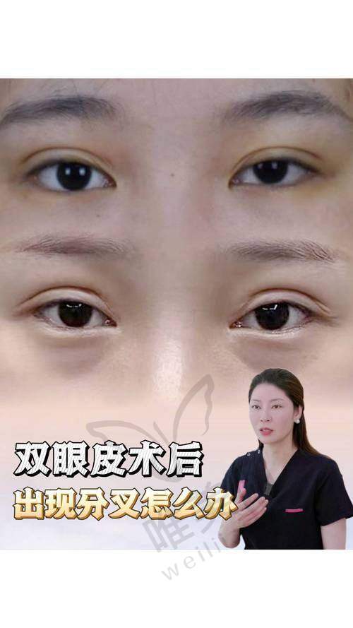 2025年北京邵祯双眼皮价目表及适合人群