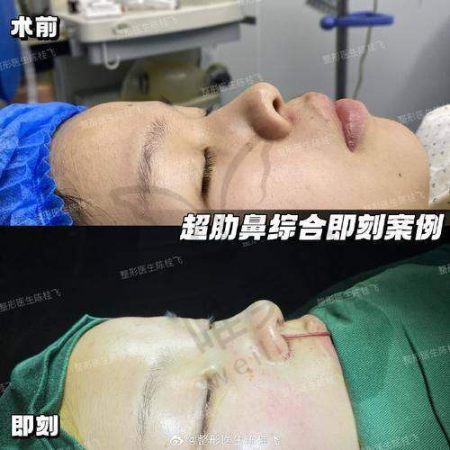 南京曹海峰医生鼻整形避坑警报