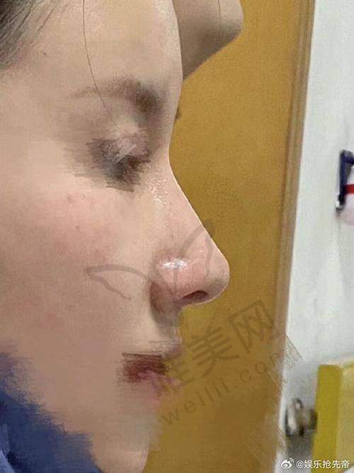 南京曹海峰医生鼻整形结尾总结
