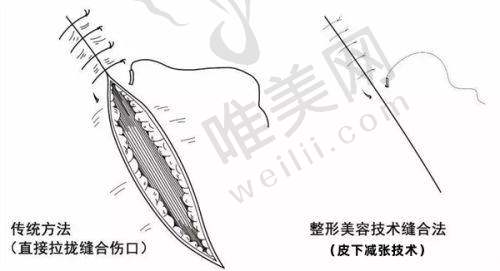 预约田芳斌做双眼皮修复怎么样?显微镜操作精细损伤小