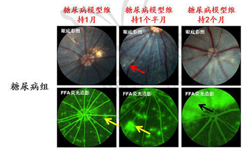 商洛眼科医院糖尿病视网膜病变与白内障示意图