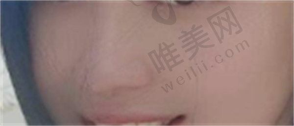 胡勇做的鼻部修复技术怎么样