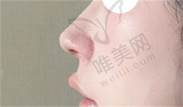 刘学宝做鼻部整形手术过程