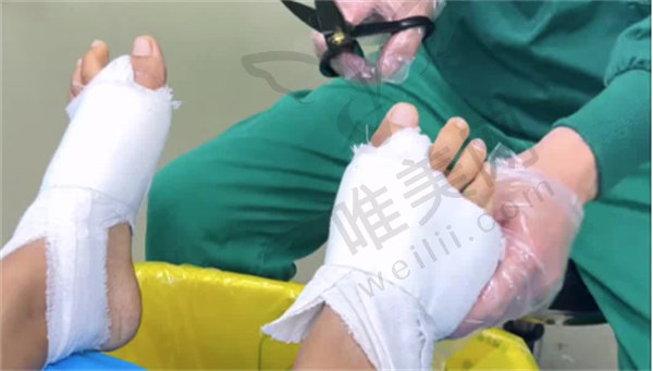 温建民微创拇外翻技术