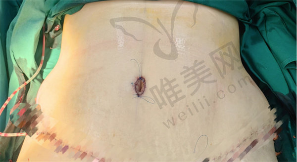 夏学颖做腹壁手术