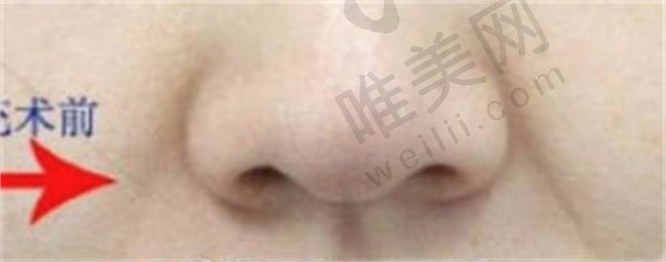 大庆娇澜蒂斯医疗美容诊所李詹哲做自体脂肪填充怎么样