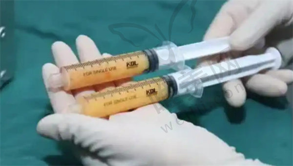 李詹哲做自体脂肪填充技术特色