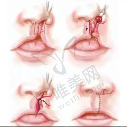 重庆松山医院唇腭裂修复手术医生