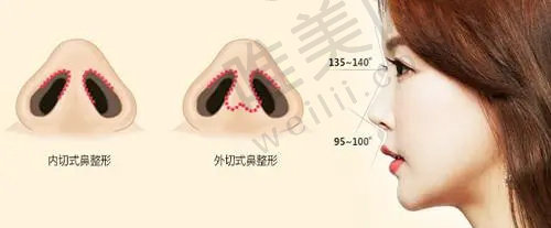 王良发医生鼻整形手术价格 王良发医生鼻整形手术价格