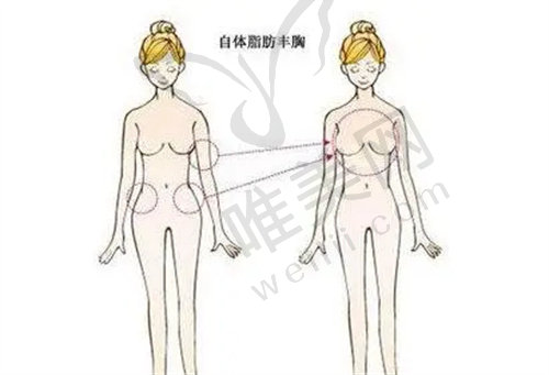 广州市荔湾区人民医院胸部整形价格