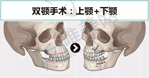 重庆松山医院双颌矫正手术医生